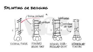 Principles of Fracture Fixation | Orthopedic Basics