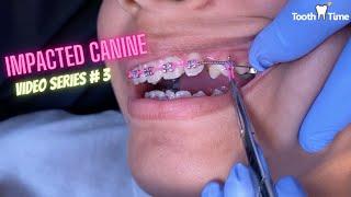 Impacted Canine Braces Treatment - Video 3 - Tooth Time Family Dentistry New Braunfels