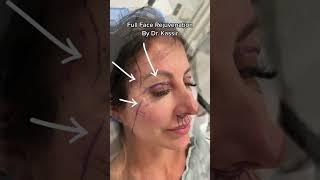 Full Face Rejuvenation (Natural Face & Neck Lift)