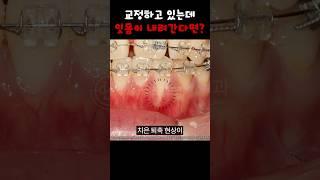 예뻐지려고 교정했는데 잇몸이 내려가 버렸다;; | 교정 부작용, 잇몸 퇴축