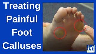 How to Treat Painful Foot Calluses