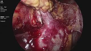 lap Nephrectomy