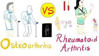 Rheumatoid Arthritis (RA) vs Osteoarthritis (OA) - Rheumatology Series