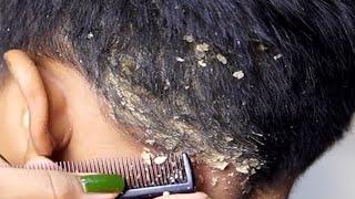 Dandruff scratching removal on head using black combing#190