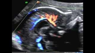 ISUOG: How to image the fetal corpus callosum: course of the pericallosal artery