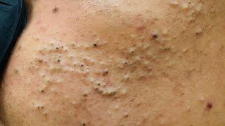 Anua Deep Cleansing Skincare Routine (For Clear, Pimple-Free Skin)
