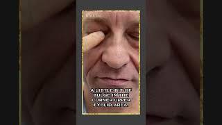 Facelift For Men? Male Ponytail Facelift