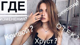 Год после РИНОПЛАСТИКИ/Дипроспан!ОТЕК?Почему нос ХРУСТИТ?