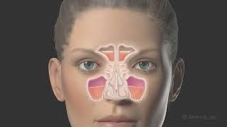 Functional endoscopic sinus surgery (FESS) - 3D animation