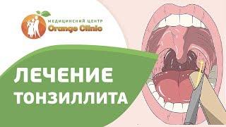  Как проводится лазерная абляция миндалин. Абляция миндалин. Оранж Клинк. 12+