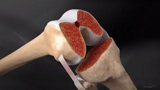 iBalance® TKA Ligament Balancing Surgical Technique