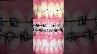 BEST Braces Treatment in Delhi Revealed