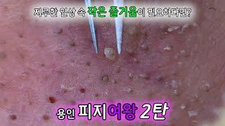 피지 직접 뽑아드렸습니다 -  피지계 왕족 계보를 잇는 용인사는 20대 생기발랄 피지여왕 2탄