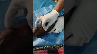 Procedure ofAV fistula cannulation #dialysis  #hospital #dialysis #viralvideo#viralvideo