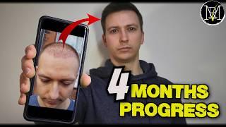 My 3rd Hair Transplant Progress! HOW LONG Will It Take?!?