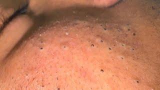 ACNE ANNIHILATOR - Skincare Routine To Treat Pimples By Mai Ngoc
