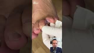 DOCTOR REACTS: FUNGUS INFECTION BETWEEN TOES! #shorts #reaction