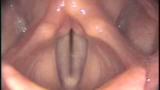 Stroboscopy: Rigid: Normal female vocal cords - glide up