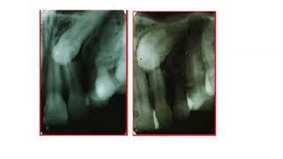 Localization of impacted canine by Parallax or CBCT