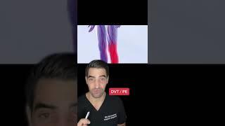 Orthopedic surgeon discusses deep vein thrombosis and blot clots as well as pulmonary embolus