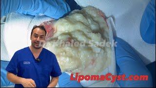 World’s largest chest cyst . Dr Khaled Sadek. LipomaCyst.com