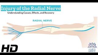 Radial Nerve Injury: What You Need to Know