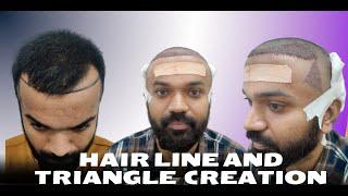 Hair Transplant in indore | Best Results & Cost of Hair Transplant in indore