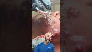 Reacting to SEVERE cystic acne (credit:@theacnelab on TT) #skincare #foryoupage #doctor #satisfying