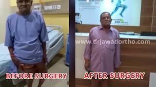 Bilateral Knees Replacement Surgery for  Gross knee deformity at Germanten Hospital,Hyderabad