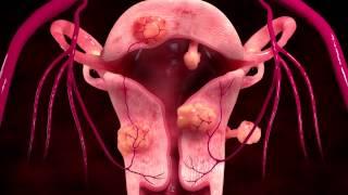 Uterine Fibroid Embolization Treatment