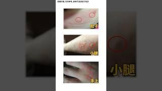 謹慎！這些根本不是蚊子咬的包，千萬別撓 #中医 #中醫 #健康 #健康科普 #涨知识 #医学科普 #知识分享 #科普 #養生 #皮肤病