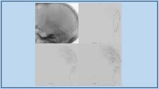 2020 08 23 BANANAZ BITES MMA embo occipital artery