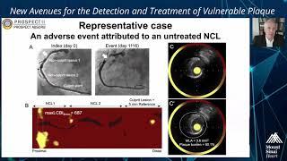 Identification of Vulnerable Plaque: From PROSPECT to LRP and PROSPECT II - Dr. David Erlinge