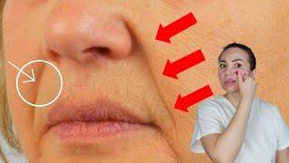 Effective techniques for those NASOLABIAL FOLDS | Massive NASOLABIAL FOLDS