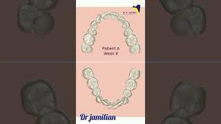 How does the  clear aligner work  in orthodontics #orthodontics #orthodontist #aligner #invisalign