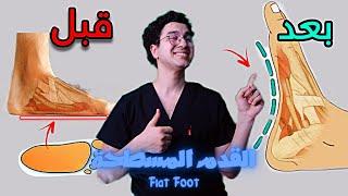 تمارين علاج الفلات فوت | علاج القدم المسطحة - Flat Foot Exercise