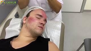 ‍‍ Dermatokosmetoloq Phd.Dr.Leyla Süleymanova- Mikronidilinq proseduru