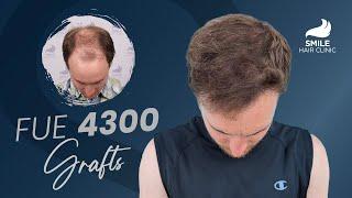 9-Month Hair Transformation | 4300 Grafts Before & After | Smile Hair Clinic