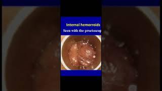 Hemorrhoids