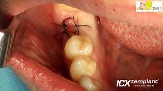 Minimalinvasive verzögerte Sofortimplantation von einem ICX-templant® Implantat im Unterkiefer