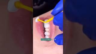 #виниры без обточки зубов #виниры #стоматология #dentist #полезно #dentalclinic #коронки #smile