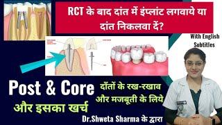 Post And Core Dental Procedure| After Root Canal Treatment| Step By Step| Cost