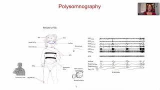 Polysomnography by Dr Refika Ersu