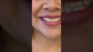 Small Teeth Smile Makeover By Dr. Tejas Patel #shorts