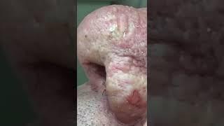 #Throwback to 'Mr  Wilson' and his amazing blackheads