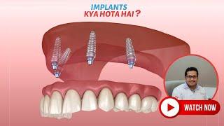 Implants Kya Hota Hai? इम्प्लांट्स क्या होता है? Dental Insights by Dr Chirag Chamria | Royal Dental