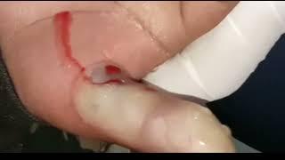 Pus video ‼️ || Abscess over Thumb ||خراج || #whatilearntoday