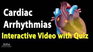 NEW: INTERACTIVE Animation with Quiz: Cardiac Arrhythmias