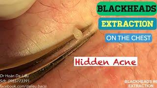 Nặn mụn đầu đen|Squeeze hidden acne, whiteheads blackheads extraction 0985773391 Hidden Acne