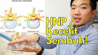 Sakit pinggang: Sembuhin saraf kejepit / kecetit / HNP dengan 2 latihan rehabilitasi